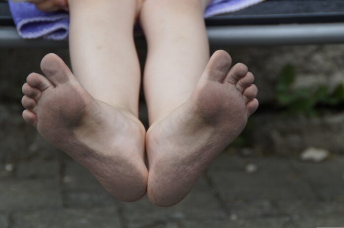 The Safe Way To Remove A Foot Callus